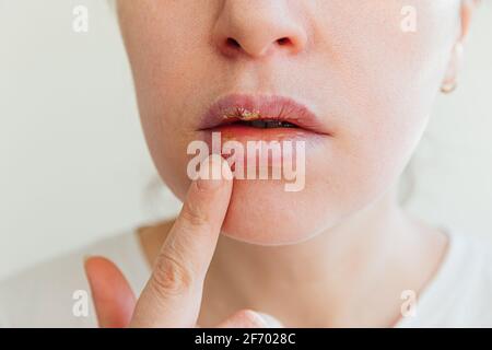 Nahaufnahme von Mädchen Lippen von Herpes betroffen. Behandlung von Herpes-Infektion und Virus. Teil der jungen Frau Gesicht mit Finger berühren Schmerzen auf den Lippen mit ihr Stockfoto