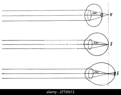 Weitsichtigkeit, normale und Kurzsichtigkeit (von oben nach unten). Illustration des 19. Jahrhunderts. Deutschland. Weißer Hintergrund. Stockfoto