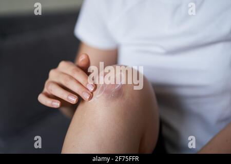 Nahaufnahme einer Person Reibecreme für die Heilung von verletzten Kniegelenk. Blutergüsse am Knie. Beinschmerzen. Stockfoto