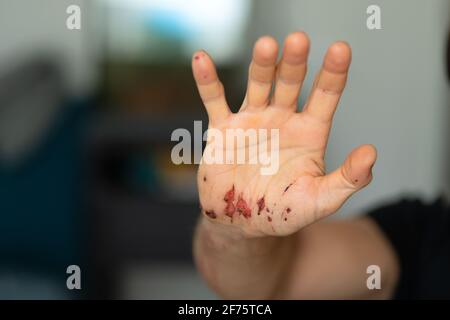 Abschürfungen an der Handfläche und Kratzer am rechten Arm eines erwachsenen Mannes. Behandlung zu Hause. Stockfoto