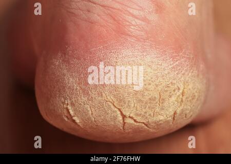 Nahaufnahme der gebrochenen Ferse eines Mannes. Problembereich des Fußes, der eine medizinische und kosmetische Behandlung erfordert. Raue vergilbte trockene Haut stirbt teilweise ab. Stockfoto