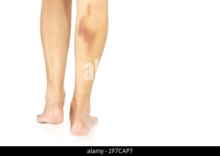 Große Blutergüsse auf dem weiblichen Bein isoliert in Schneideweg. Stockfoto