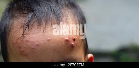 Ein asiatisches Kind mit einer Allergie auf der Stirn Zu ungeeigneten Lebensmitteln Stockfoto