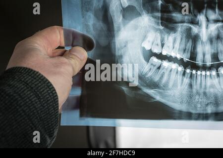 Die Hand ist sichtbar und hält eine Röntgenaufnahme einer Person mit Zahnspangen an den Zähnen, mit sichtbaren Spuren bewegter Zähne, wie gebogene Wurzeln. Zwei obere Zähne a Stockfoto