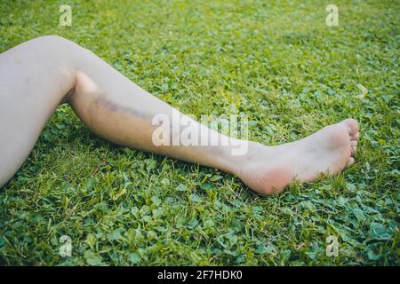 Bein einer Frau mit sichtbarem großen blauen und gelben Blutergüssen auf dem Wadenmuskel, aufgrund von Aufprall oder starkem Druck auf das Gewebe des Beins. Außenaufnahme auf einem Stockfoto