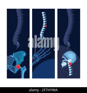 Rheumatology Blue Bones Poster Set Stock Vektor