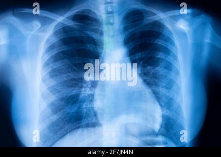 Ergebnis des Röntgenscans der Lungenrippen. Stockfoto