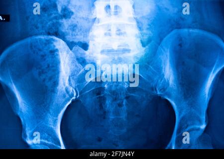 Ergebnis des Scans des Hüftbeckens. Stockfoto