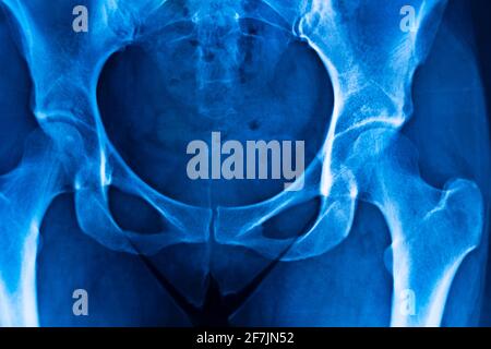 Ergebnis des Scans des Hüftbeckens. Stockfoto