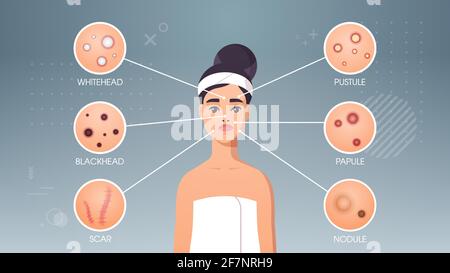 Gesichtshaut Pickel Akne verschiedene Arten auf Frau Gesicht Pore Komedonen Kosmetologie Hautprobleme Konzept flach Porträt horizontal Stock Vektor