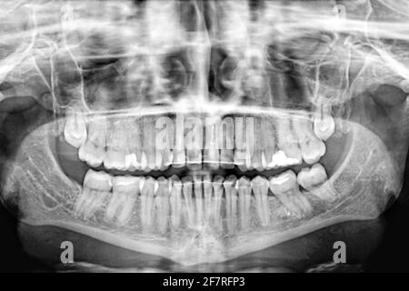Panorama-Röntgenaufnahme von menschlichen Zähnen.Untersuchung und Behandlung. Zahnpflege.Banner. Stockfoto