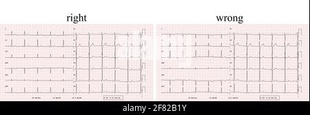 EKG-Beispiel für einen normalen 12-Kanal-Sinusrhythmus, Vergleich der korrekten und falschen Positionierung der Elektrode Stockfoto