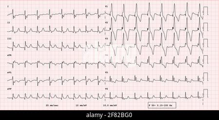 EKG-Beispiel für einen pathologischen 12-Kanal-Rhythmus, Fallots Tetralogie Stockfoto