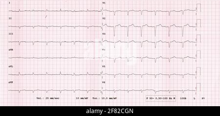 12-Kanal-EKG-Rhythmus, Beispiel für seltene Pathologie Amyloidose Stockfoto