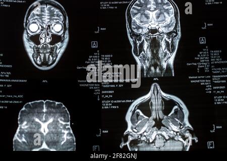 Magnetresonanztomographie des Gehirns aus nächster Nähe. MRT Stockfoto