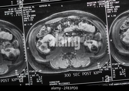 Magnetresonanztomographie, MRT, Computertomographie, Röntgenbild. Bauchbereich im Querschnittsbereich des ​​the Beckens mit Nieren, die mit tum infiziert sind Stockfoto