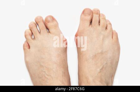 Varus valgus und Hallux valgus, Bunion auf weißem Hintergrund. Mit Beschneidungspfad Stockfoto