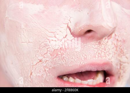 Männliche Schönheit. Akne. Hautprobleme. Stockfoto