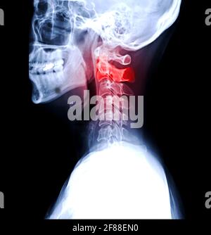 Röntgenaufnahme der Halswirbelsäule oder Röntgenaufnahme der lateralen Ansicht der Halswirbelsäule für diagnostische Bandscheibenvorfall und Spondylose. Stockfoto