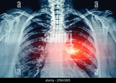 Röntgenfilm mit Korn Bild der menschlichen Brust und Lunge medizinische Diagnose mit rotem Bereich als Symbol für Punkt von Schmerz und Krankheit. Stockfoto