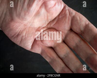 Dupuytrens Kontraktur in der linken Hand Stockfoto