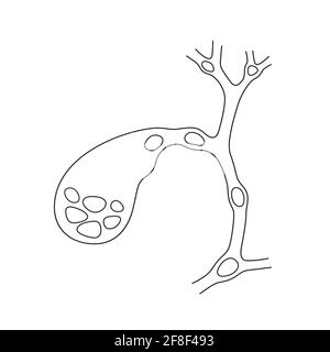 Varianten der Lage von Steinen in der Gallenblase und Gallengänge. Schematische Zeichnung für Cholelithiasis, Gallensteinkrankheit. Stock Vektor