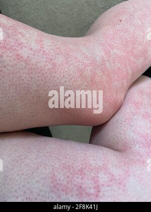 Fleckiger Hauthitzeausschlag Nesselsucht allergische Reaktion auf Nahaufnahme des Knies Referenzbild von fleckig fleckig rot gefärbtem Hauterythem ab igne, auch bekannt als EAI Stockfoto