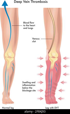 Medizinische Darstellung der Symptome einer tiefen Venenthrombose, mit Anmerkungen. Stock Vektor