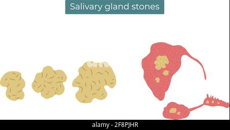 Vektor-flache Darstellung von Steinen in den Ohrspeicheldrüsen, submandibulären und sublingualen Speicheldrüsen. Stock Vektor