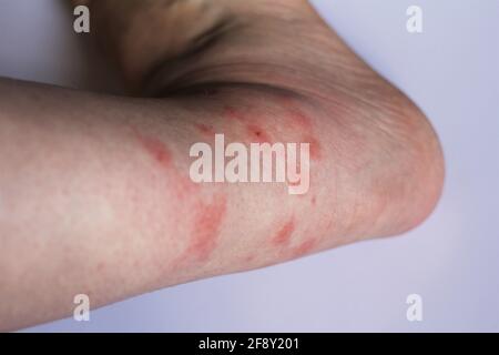 Selektiver Fokus auf den Knöchel. Das Bein einer Frau mit mehreren Mückenstichen, die eine Entzündung in der Haut um den geschwollenen Knöchel verursachen. Allergische Reaktion Stockfoto