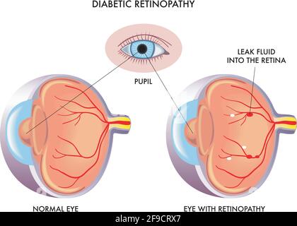 Medizinische Illustration vergleicht ein normales Auge mit einem mit diabetischer Retinopathie, mit Anmerkungen. Stock Vektor