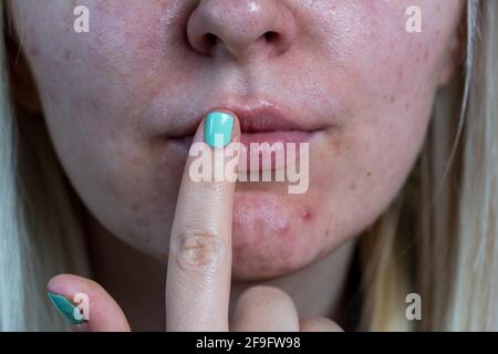 Ein Teil des Gesichts einer jungen Frau mit einem Virus Herpes auf den Lippen, Behandlung mit Salbe. Junge Frau mit Lippenherpes, die Creme auf die Lippen auftragen Stockfoto