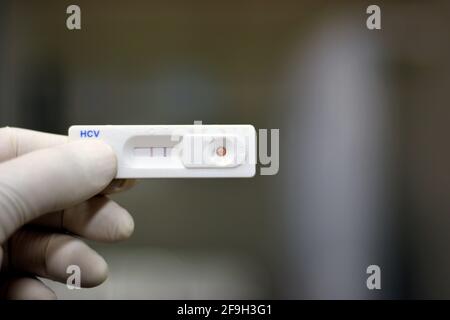 Ein positives Ergebnis für die Hepatitis C-Schnelltestkassette, die Antikörper des Hepatitis C-Virus kontrolliert, die von medizinischem Personal gehalten werden Stockfoto