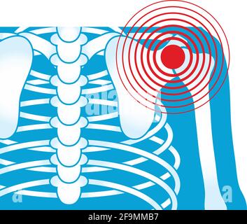 Symbol für rheumatologische Schmerzen an der Schulter Stock Vektor