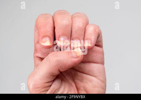 Onychomykose oder Pilzinfektion auf beschädigten Nägeln nach Gelpolitur, Onyose. Längsridging Nägel mit Psoriasis. Nagelkrankheiten, Gesundheit Stockfoto