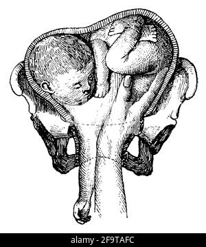 Geburtshilfe in der Pathologie. Schulterpräsentation. Illustration des 19. Jahrhunderts. Deutschland. Weißer Hintergrund. Stockfoto