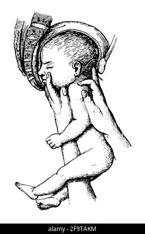 Geburtshilfe. Geburt. Illustration des 19. Jahrhunderts. Deutschland. Weißer Hintergrund. Stockfoto