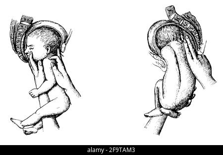 Geburtshilfe. Geburt. Illustration des 19. Jahrhunderts. Deutschland. Weißer Hintergrund. Stockfoto