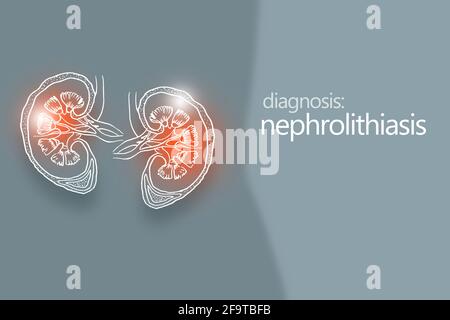 Nephrolithiasis Nierensteine Krankheit oder Urolithiasis. Nierenrechnung oder Steine, die die Harnwege blockieren.Designvorlage im minimalistischen Stil Stockfoto