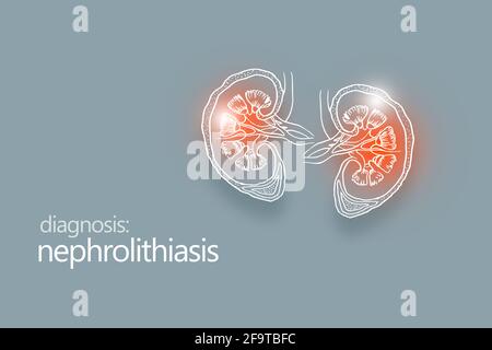 Nephrolithiasis Nierensteine Krankheit oder Urolithiasis. Nierenrechnung oder Steine, die die Harnwege blockieren.Designvorlage im minimalistischen Stil Stockfoto