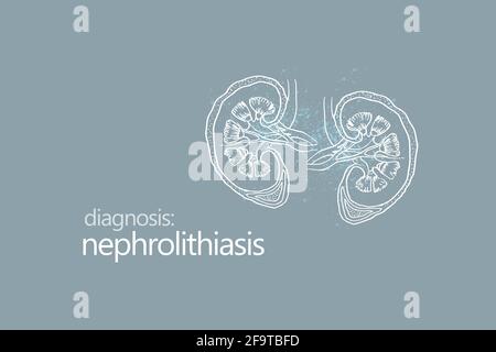 Nephrolithiasis Nierensteine Krankheit oder Urolithiasis. Nierenrechnung oder Steine, die die Harnwege blockieren.Designvorlage im minimalistischen Stil Stockfoto