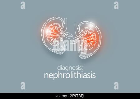 Nephrolithiasis Nierensteine Krankheit oder Urolithiasis. Nierenrechnung oder Steine, die die Harnwege blockieren.Designvorlage im minimalistischen Stil Stockfoto