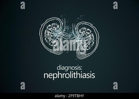 Nephrolithiasis Nierensteine Krankheit oder Urolithiasis. Nierenrechnung oder Steine, die die Harnwege blockieren.Designvorlage im minimalistischen Stil Stockfoto