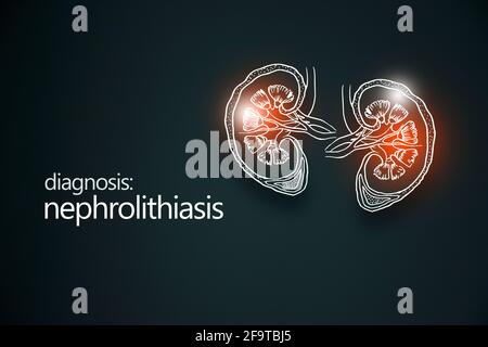 Nephrolithiasis Nierensteine Krankheit oder Urolithiasis. Nierenrechnung oder Steine, die die Harnwege blockieren.Designvorlage im minimalistischen Stil Stockfoto