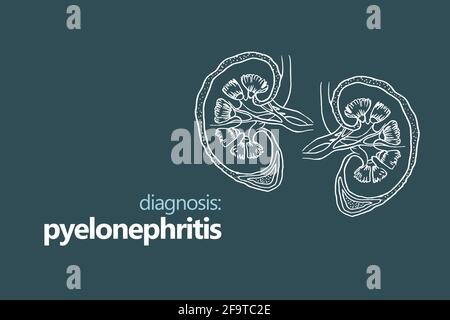 Pyelonephritis, eine Entzündung der Niere, typischerweise aufgrund einer bakteriellen Infektion. Minimalistischer Stil Design-Vorlage mit handgezeichneter Orgel Stockfoto