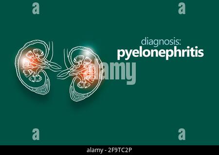 Pyelonephritis, eine Entzündung der Niere, typischerweise aufgrund einer bakteriellen Infektion. Minimalistischer Stil Design-Vorlage mit handgezeichneter Orgel Stockfoto
