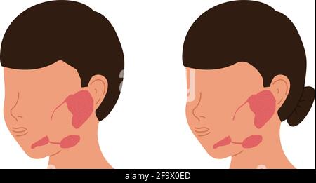 Lokalisation der Speicheldrüsen bei Männchen und Weibchen. Medizinische Vektordarstellung. Stock Vektor