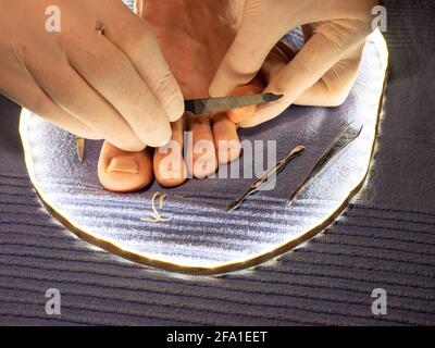 Hände in weißen sterilen Handschuhen feilten Zehennägel mit langer spitzer Feile auf männlichen Zehen. Pediküre auf blauem Handtuch Stockfoto