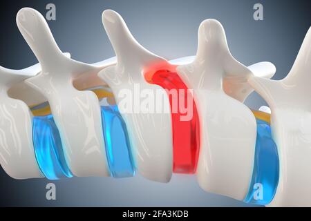 Bandscheibenvorfall komprimiert das Rückenmark und verursacht Rückenschmerzen und andere gesundheitliche Probleme, 3D-Illustration Stockfoto