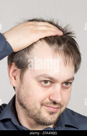 Der Mann zeigt eine hohe Stirn mit rückläufiger Haarlinie. Haarausfall bei Männern, Haarpflege Stockfoto